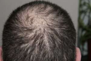 How to know if you have male pattern baldness